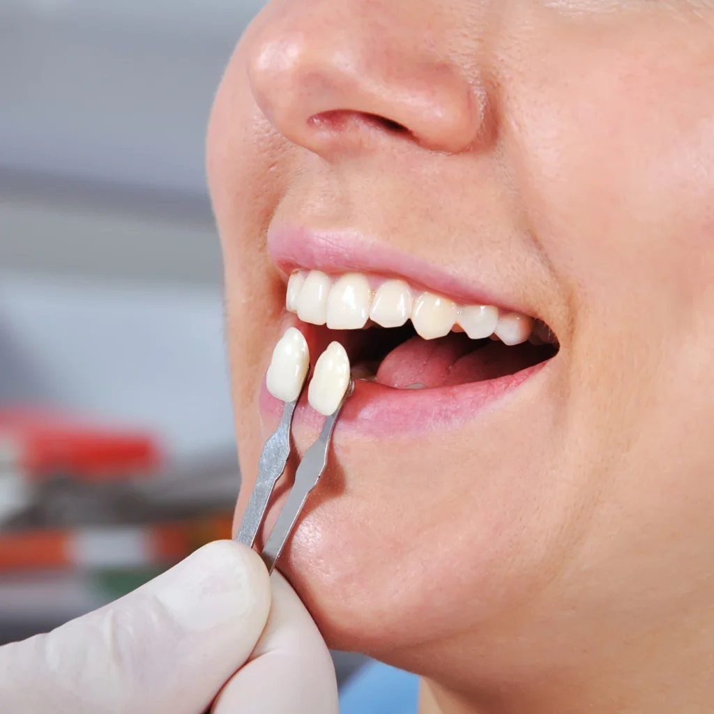 faccette dentali a Rovigo